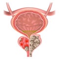 Prostate adenoma.